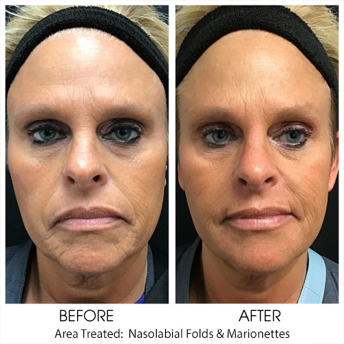 Before + After Gallery: Face