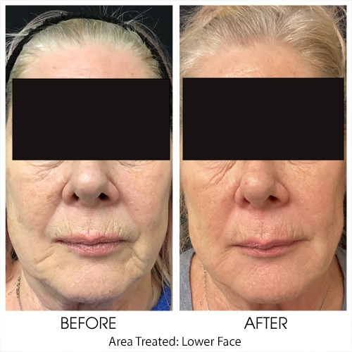 Before + After Gallery: Face