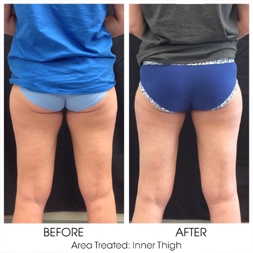 Before + After Gallery: Body