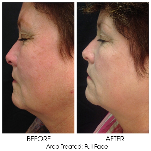 Before + After Gallery: Face