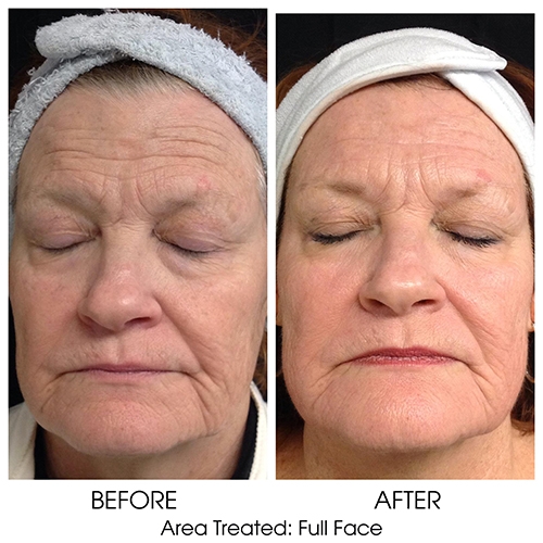 Before + After Gallery: Face