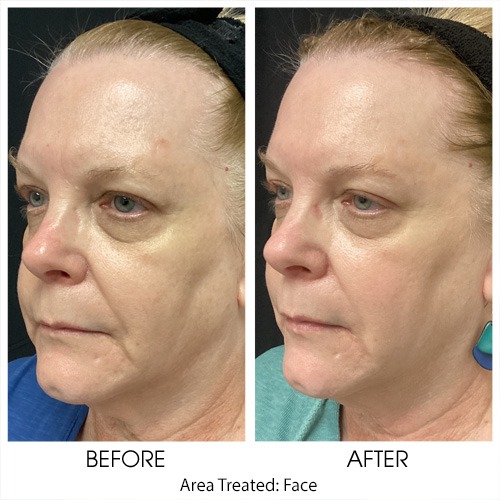 Before + After Gallery: Face