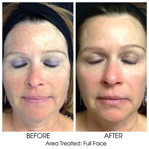 Before + After Gallery: Face